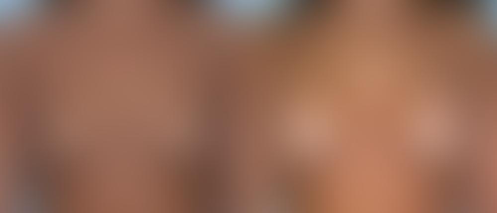 Breast Augmentation Before and After Photos in Newburgh, NY, Patient 12326