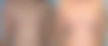 Breast Augmentation Before and After Photos in Montvale, NJ, Patient 12350