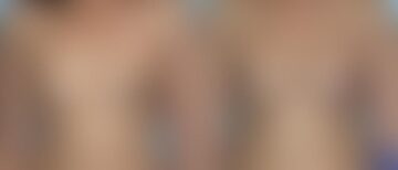 Breast Augmentation Before and After Photos in Montvale, NJ, Patient 12357