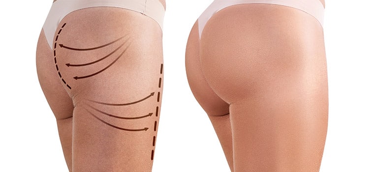  Sculptra Butt Lift