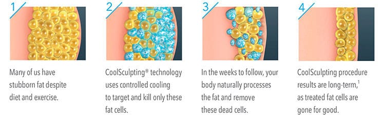 CoolSculpting uses Cryolipolysis, a remarkable new technique that employs cold temperatures to destroy deep layers of fat cells.