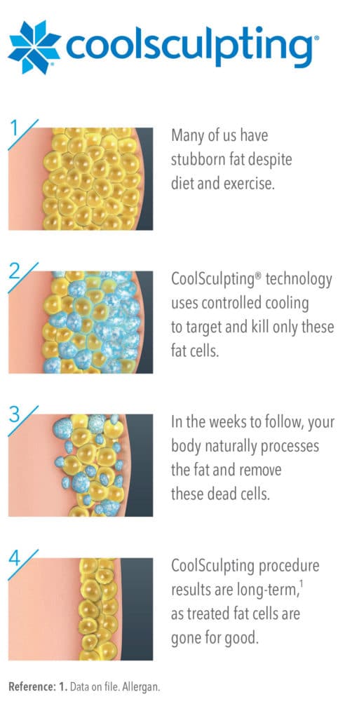 CoolSculpting uses Cryolipolysis, a remarkable new technique that employs cold temperatures to destroy deep layers of fat cells.