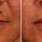 Lip Fillers Before and After Photos in Newburgh, NY, Patient 12725