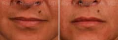 Lip Fillers Before and After Photos in Newburgh, NY, Patient 12725