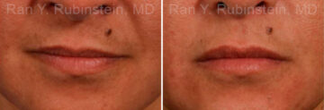 Lip Fillers Before and After Photos in Montvale, NJ, Patient 12725
