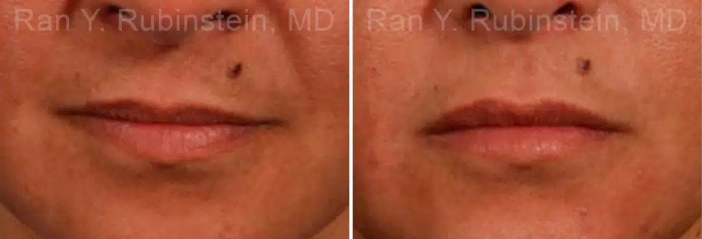 Lip Fillers Before and After Photos in Newburgh, NY, Patient 12725