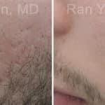 Microneedling RF Before and After Photos in Newburgh, NY, Patient 16582