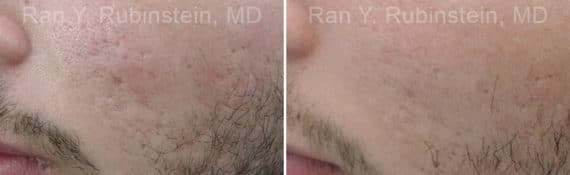 Microneedling RF Before and After Photos in Newburgh, NY, Patient 16582