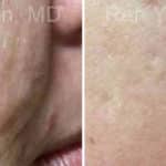 Microneedling RF Before and After Photos in Newburgh, NY, Patient 16586