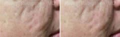 Microneedling RF Before and After Photos in Newburgh, NY, Patient 16586