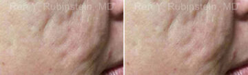 Microneedling RF Before and After Photos in Montvale, NJ, Patient 16586