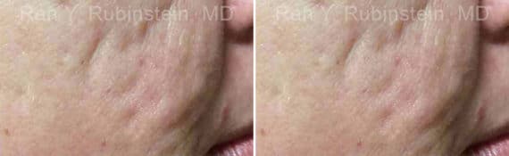 Microneedling RF Before and After Photos in Newburgh, NY, Patient 16586