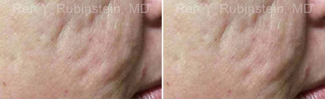 Microneedling RF Before and After Photos in Newburgh, NY, Patient 16586