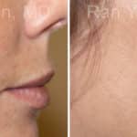 Microneedling RF Before and After Photos in Newburgh, NY, Patient 16598