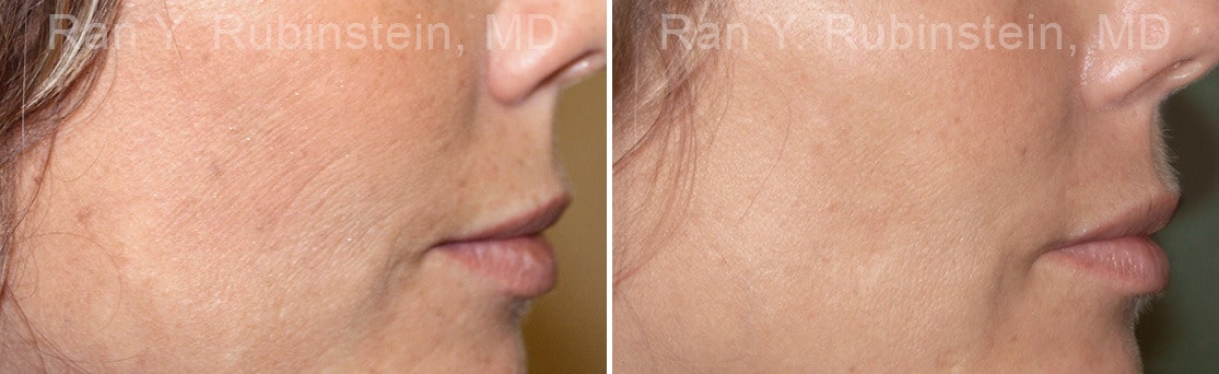 Microneedling RF Before and After Photos in Newburgh, NY, Patient 16598