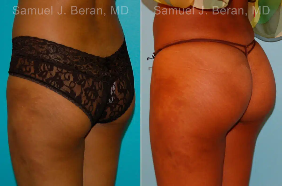 Brazilian Butt Lift Before and After Photos in Newburgh, NY, Patient 16708