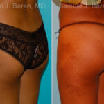 Brazilian Butt Lift Before and After Photos in Newburgh, NY, Patient 16708