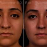 Ethnic Rhinoplasty Before and After Photos in Newburgh, NY, Patient 17240