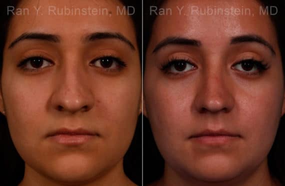 Ethnic Rhinoplasty Before and After Photos in Newburgh, NY, Patient 17240