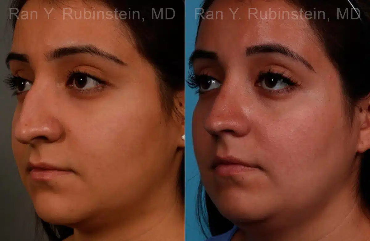 Ethnic Rhinoplasty Before and After Photos in Newburgh, NY, Patient 17240