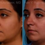 Ethnic Rhinoplasty Before and After Photos in Newburgh, NY, Patient 17240