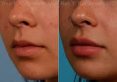 Lip Fillers Before and After Photos in Newburgh, NY, Patient 17399