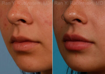 Lip Fillers Before and After Photos in Montvale, NJ, Patient 17399