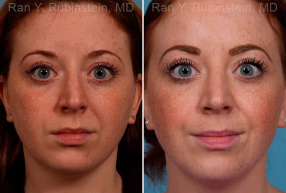 Rhinoplasty Before and After Photos in Newburgh, NY, Patient 17434