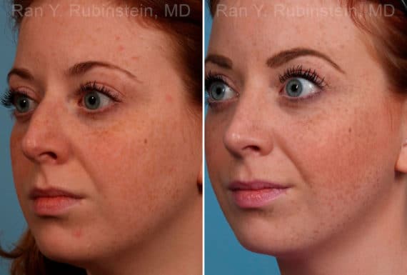 Rhinoplasty Before and After Photos in Newburgh, NY, Patient 17434