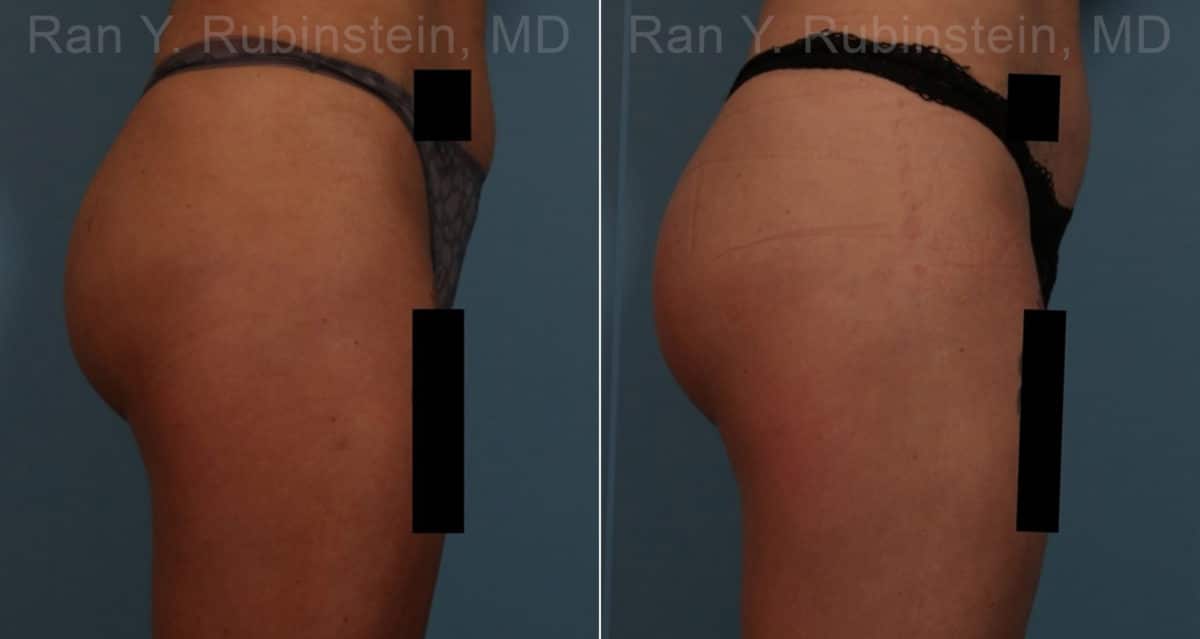 Sculptra Butt Lift Before and After Photos in Newburgh, NY, Patient 17627