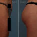 Sculptra Butt Lift Before and After Photos in Newburgh, NY, Patient 17627