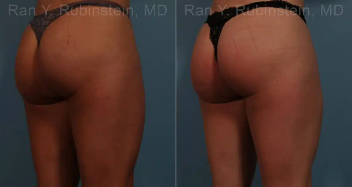 Sculptra Butt Lift Before and After Photos in Newburgh, NY, Patient 17627