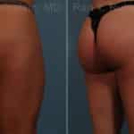 Sculptra Butt Lift Before and After Photos in Newburgh, NY, Patient 17627