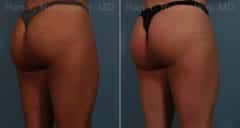 Sculptra Butt Lift Before and After Photos in Newburgh, NY, Patient 17627