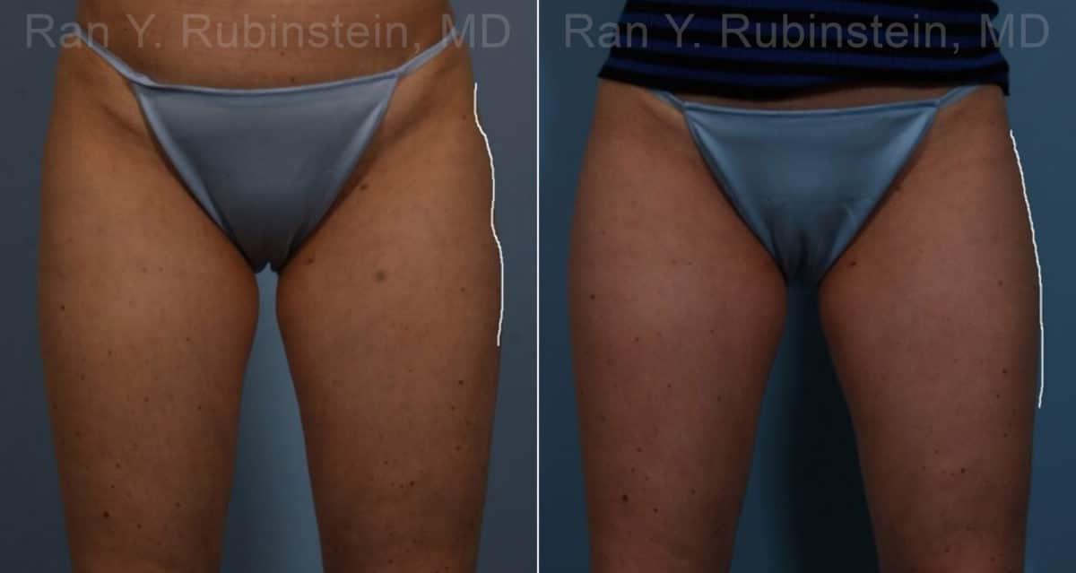 Sculptra Butt Lift Before and After Photos in Newburgh, NY, Patient 17634