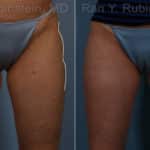 Sculptra Butt Lift Before and After Photos in Newburgh, NY, Patient 17634