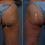 Sculptra Butt Lift Before and After Photos in Newburgh, NY, Patient 17634