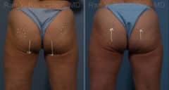 Sculptra Butt Lift Before and After Photos in Newburgh, NY, Patient 17634