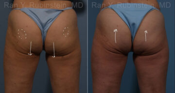 Sculptra Butt Lift Before and After Photos in Montvale, NJ, Patient 17634