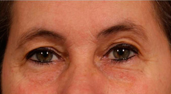 Upper Blepharoplasty - Front - Before