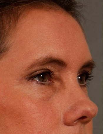 Upper Blepharoplasty - Obl Right - After