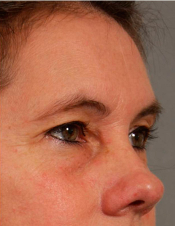 Upper Blepharoplasty - Obl Right - Before
