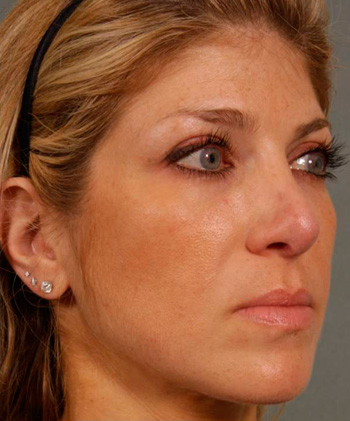 Revision Rhinoplasty - Obl Right - After