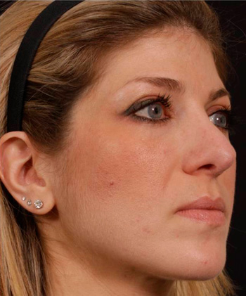 Revision Rhinoplasty - Obl Right - Before