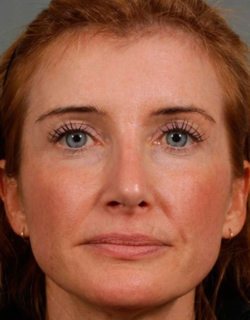 Revision Rhinoplasty - Front - After