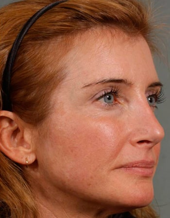 Revision Rhinoplasty - Obl Right - After