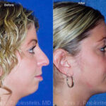 Chin Augmentation Before and After Photos in Newburgh, NY, Patient 12399