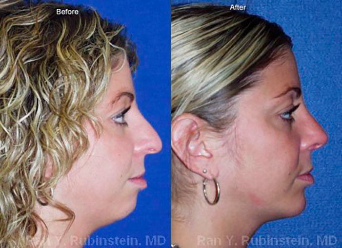 Chin Augmentation Before and After Photos in Newburgh, NY, Patient 12399