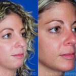 Chin Augmentation Before and After Photos in Newburgh, NY, Patient 12399