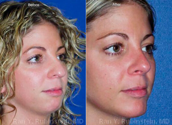 Chin Augmentation Before and After Photos in Newburgh, NY, Patient 12399